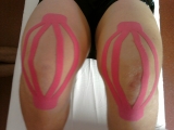 Kineziotaping